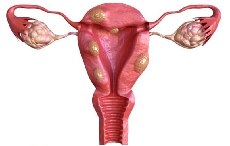 Miomas uterinos